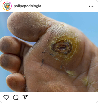 Poli-Pé, podologia, guarulhos