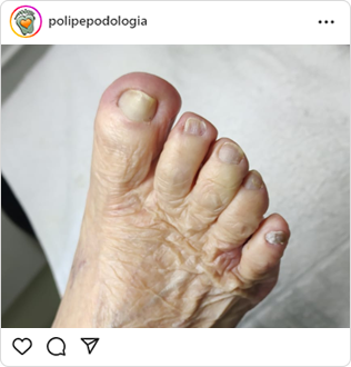 Poli-Pé, podologia, guarulhos