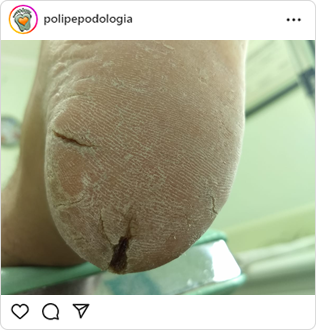 Poli-Pé, podologia, guarulhos