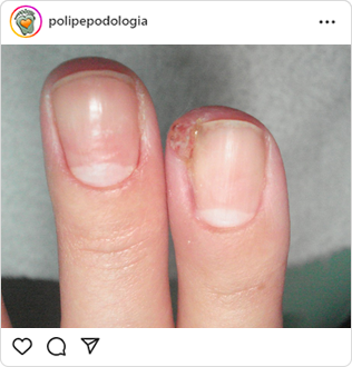 Poli-Pé, podologia, guarulhos