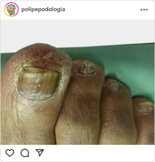 Poli-Pé, podologia, guarulhos