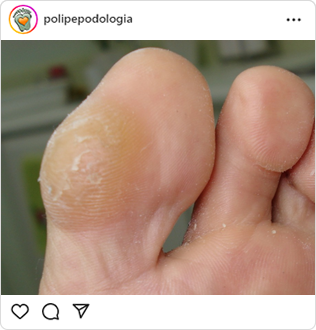 Poli-Pé, podologia, guarulhos