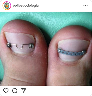 Poli-Pé, podologia, guarulhos