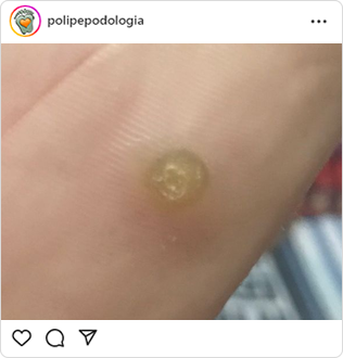 Poli-Pé, podologia, guarulhos